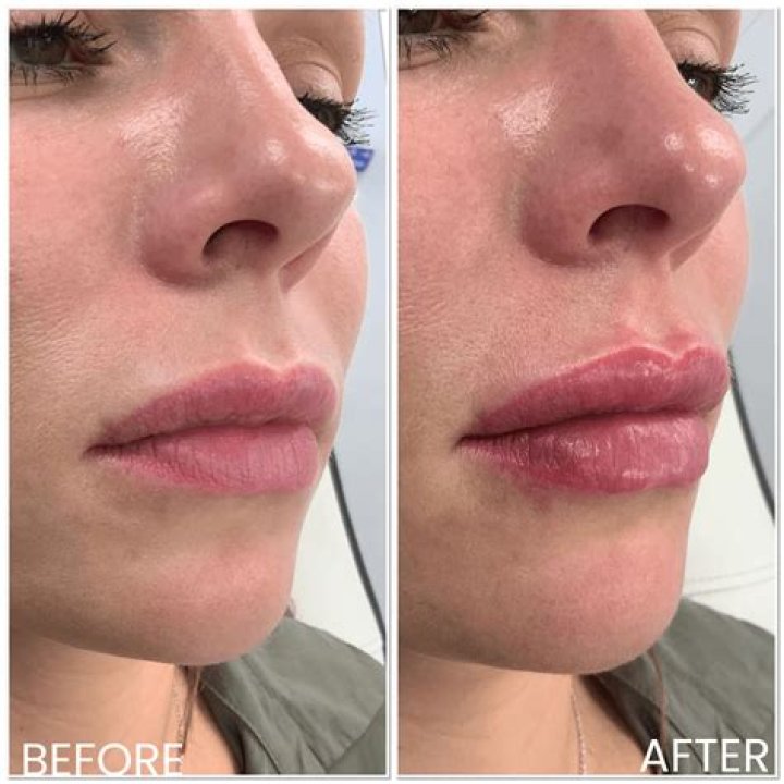 Before And After Photos Fans Suspect Lip Filler |