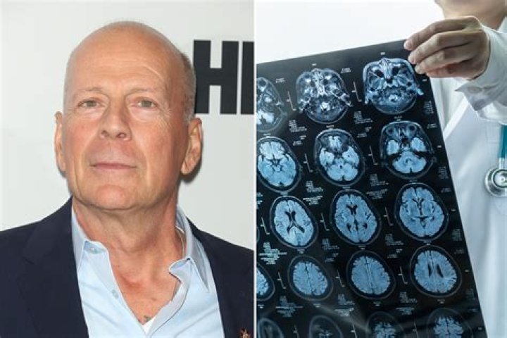 Bruce Willis's Health Journey And Medical Breakthroughs