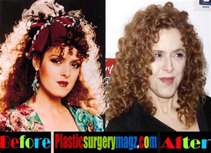 Has Bernadette Peters had Plastic Surgery: Before & After! |