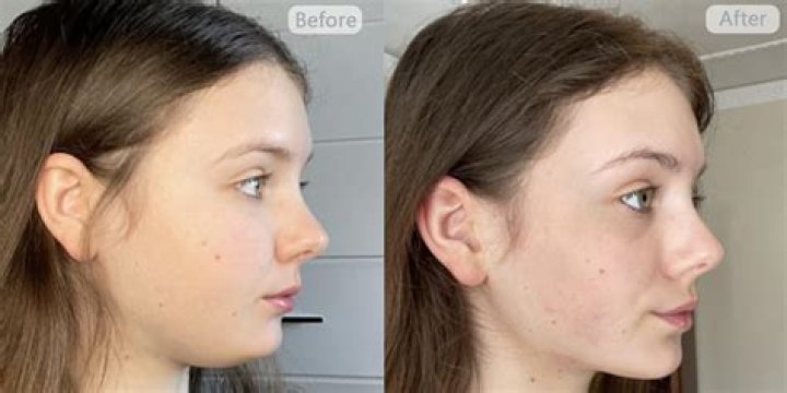 Nose Exercise Before And After