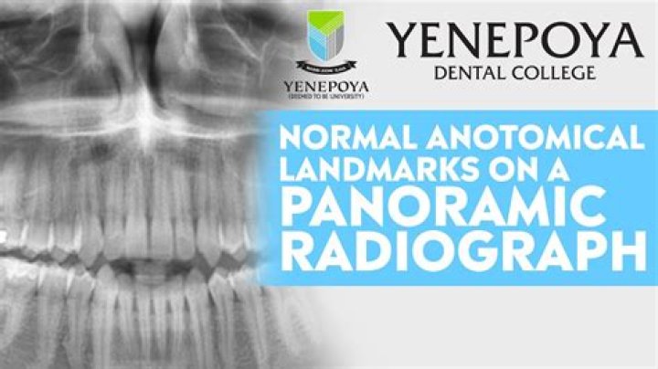 Panoramic Radiograph Normal Anatomical Landmarks Quiz
