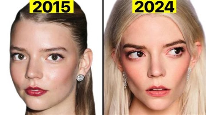 What Happened with Anya Taylor-Joys Teeth? Know the Truth |
